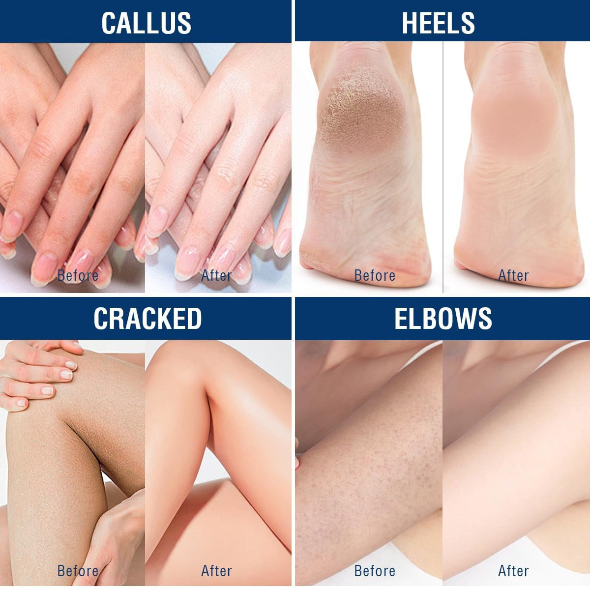 Urea Cream 40 Percent, Foot & Hand Cream for Dry Cracked, Urea Lotion for Feet M