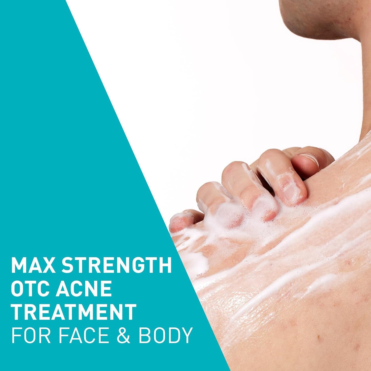 Acne Foaming Cream Wash, Gentle Face and Body Cleanser with Benzoyl Peroxide 10%