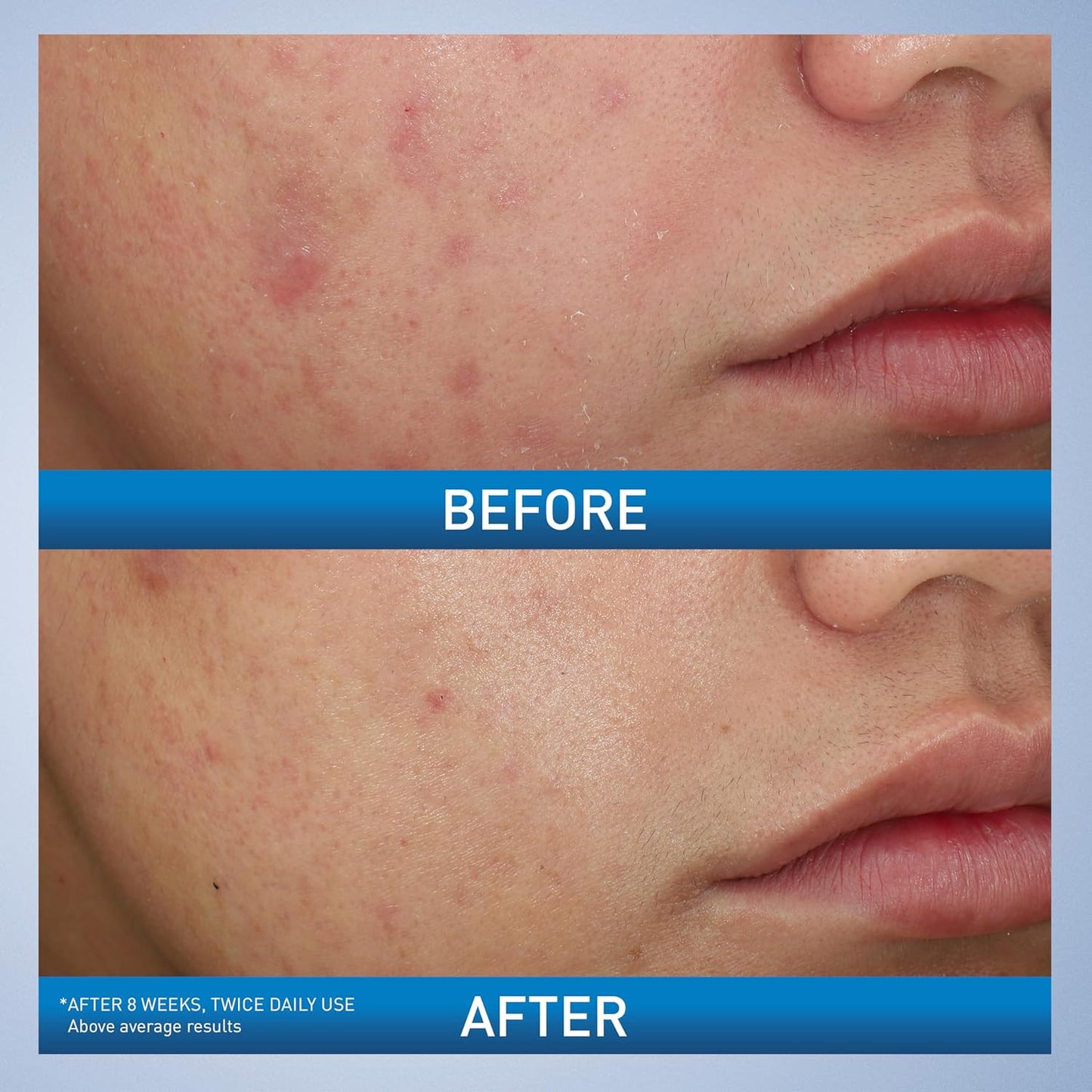 Acne Foaming Cream Wash, Gentle Face and Body Cleanser with Benzoyl Peroxide 10%