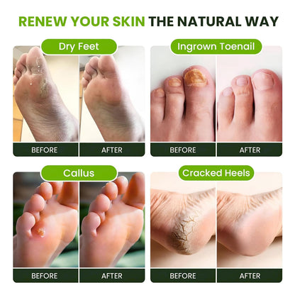 Tea Tree Oil Foot Soak with Epsom Salt - Best Toenail Fungus Treatment, Athletes