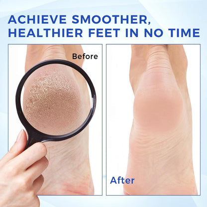 Urea Cream 40 Percent for Foot & Hand Cream with Foot Files for Dry Cracked,Urea