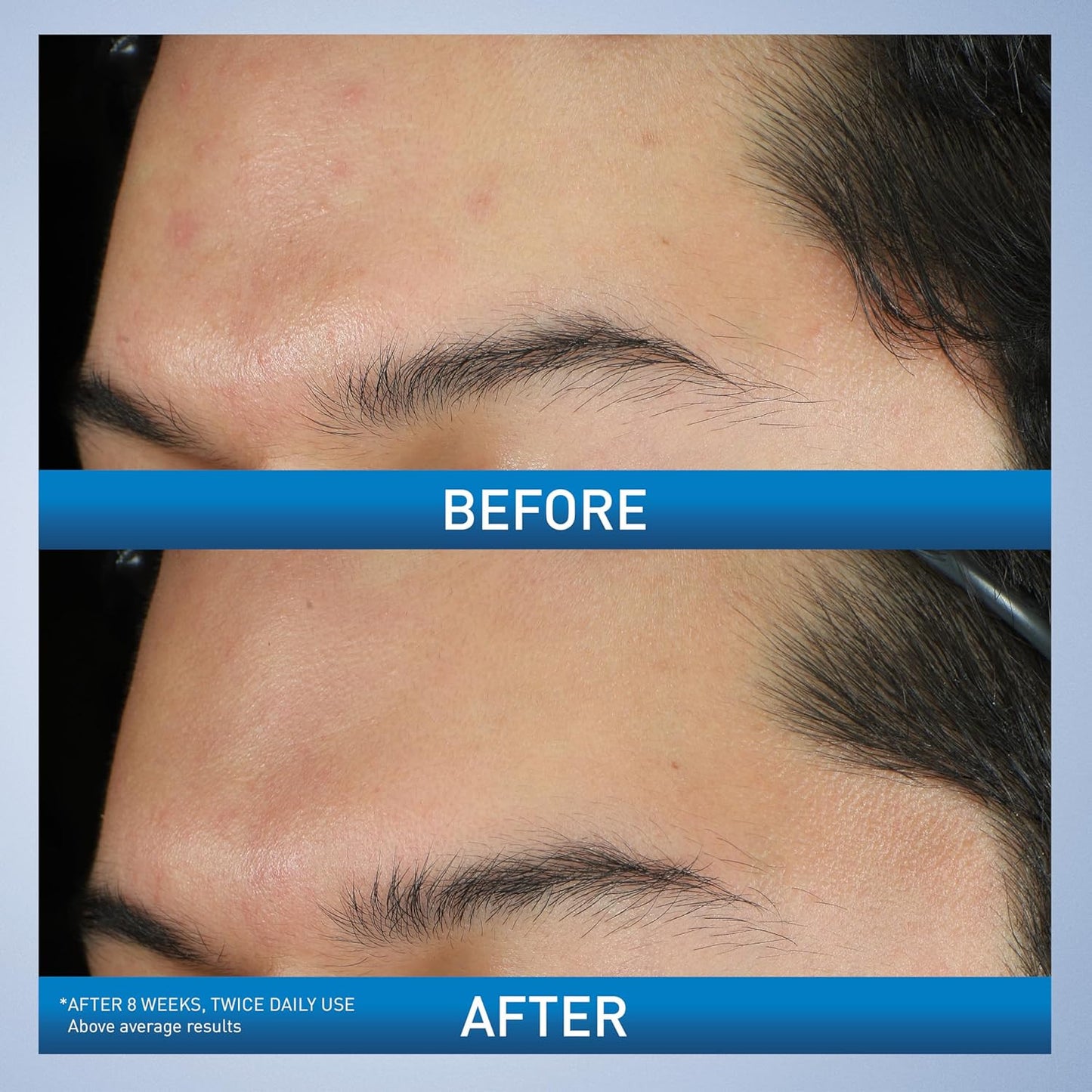 Acne Foaming Cream Wash, Gentle Face and Body Cleanser with Benzoyl Peroxide 10%